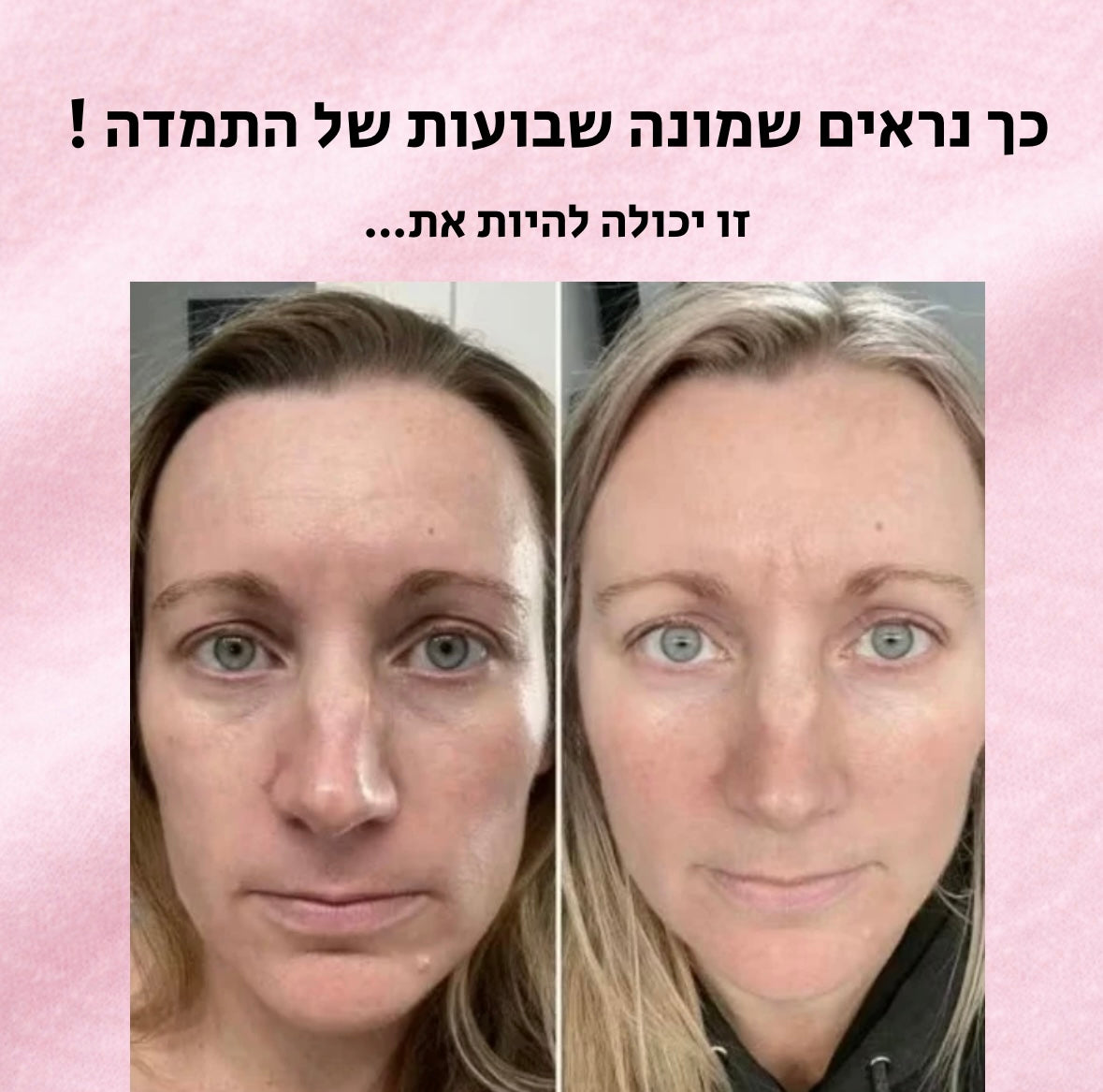 Face shaper pro - מכשיר לעיצוב הפנים